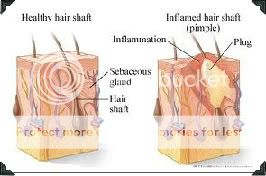 ASAP Skincare  Clearskin Gel AHA & BHA for Acne prone Skin 120ml 
